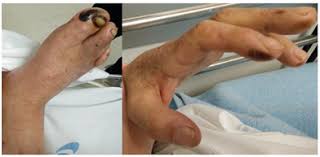 Image result for Hyperviscosity Syndrome