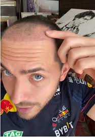 Resultados a 1 mes de mi trasplante de pelo