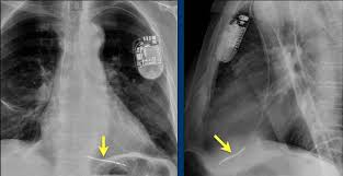 Cardiac failure, position of pacemaker, leads position. The Radiology Assistant Cardiovascular Devices