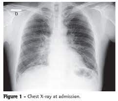 The signs and symptoms of influenza b are commonly ignored. Scielo Brasil Sindrome Respiratoria Aguda Grave Causada Por Influenza A Subtipo H1n1 Sindrome Respiratoria Aguda Grave Causada Por Influenza A Subtipo H1n1