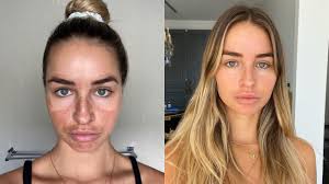 The best low-pain, non-invasive alternative beauty treatments instead of  botox, lipo and filler