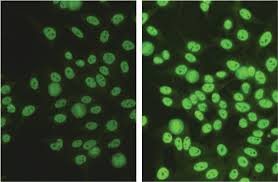 Image result for ANA Staining Pattern