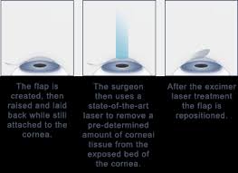 See full list on mayoclinic.org Lasik Bellevue How Lasik Works Bellevue Lasik