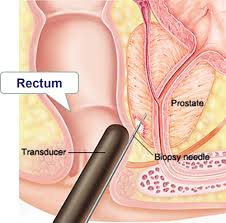 Prostate cancer may cause no signs or symptoms in its early stages. Renal Ch19 Diseases Of The Prostate Flashcards Quizlet