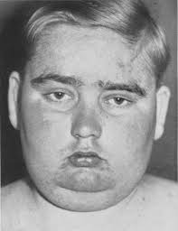 Das hypophysäre Cushing-Syndrom