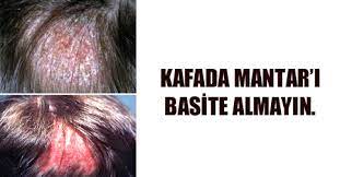 kafada mantar neden olur nasil gecer