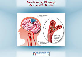 Carotid Artery Surgery In Tampa Fl To Help Prevent Stroke Carotid Artery Arteries Vein Clinic