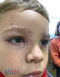 Image result for phlegmon on face)