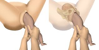 Maybe you would like to learn more about one of these? Vaginal Breech Delivery Chapter 6 Obstetric Interventions