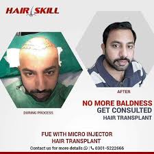Hair Transplant Cost In Lahore Hair Transplant Cost Hair Transplant Hair Regeneration