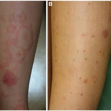 As a result, serious health problems can develop. The Cutaneous Manifestations Of Henoch Schonlein Purpura In Our Download Scientific Diagram