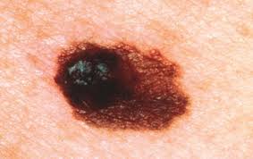 Iarc (international agency for research on cancer) agrees sunbeds are … Columnist Can Sunbeds Cause Skin Cancer