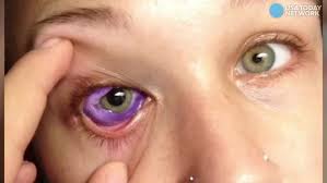 Despite the multiple surgical and antibiotic interventions for endophthalmitis, the eye was eventually enucleated due to intractable pain. Model Nearly Loses Eye After Sclera Tattoo Why She Did It Time