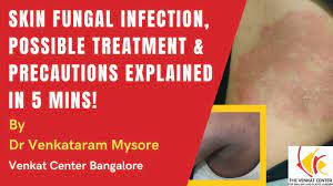 Learn vocabulary, terms and more with flashcards, games and other study tools. Fungal Infections Of Skin Venkat Center For Skin Plastic Surgery