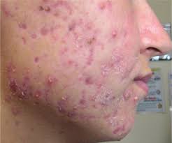 Nodules are inflammatory lesions with a diameter of 5 mm or greater. Diagnosis And Treatment Of Acne American Family Physician