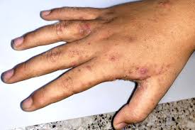 Image result for scabies human bites
