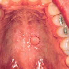 .buccal mucosa fibroma, mucocele, mesenchymal tumor, salivary tumor, squamous cell carcinoma gingiva parulis, pyogenic granuloma, peripheral fibroma, peripheral giant cell granuloma, peripheral. Buccal Mucosa An Overview Sciencedirect Topics