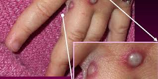 Jun 10, 2021 · monkeypox is a rare disease that is caused by infection with monkeypox virus. Mcdpfweh5byahm