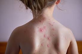 Image result for shingles in children