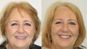 Senior and Adult Braces