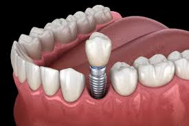 Image result for dental implant