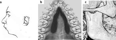 Image result for Micrognathia