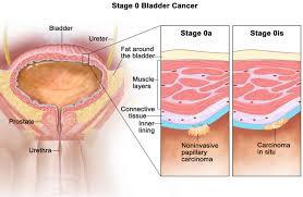 A propagating malignant tumor, 1721, from latin carcinoma, from greek karkinoma a cancer, from… related: Carcinoma In Situ Definition Breast Skin Cervix Bladder