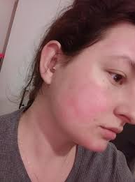 Kızarıklık ve Yanık Kremi Şikayetleri