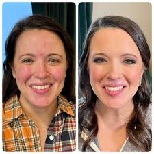 Airbrushed to combat rosacea 💗 #ginageigermakeupartist #makeupartist #mua  #bridalmakeup #bridesmaids #liweddings #airbrushmakeup #flawless #temptu  #beforeanaftermakeup #roseacea