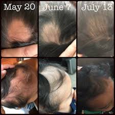 Last February My 3 Year Old Son Was Diagnosed With Alopecia He Was Prescribed All Sorts Of Steroids And Creams Hair Loss Remedies Baby Hair Growth Grow Hair