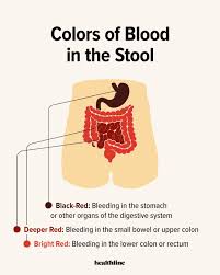 Image result for Blood in stool