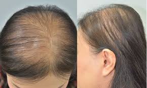 Depending upon the causes and the severity of the condition, the hair loss. Full Text Parietal Scalp Is Another Affected Area In Female Pattern Hair Loss A Ccid