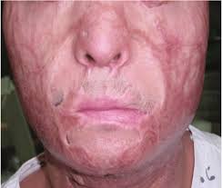 Perinasal burn scar contractures. The size of nasal orifices should be...