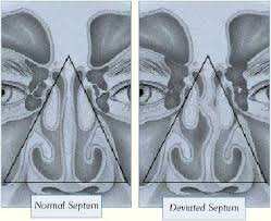 Nasal polyp causes and risk factors. Chronic Sinusitis Allergy Asthma And Sinus Specialists City Allergy