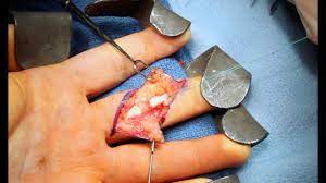 A biomechanical and morphological study in dogs. Live Surgery Flexor Digitorum Profundus Fdp Finger Tendon Repair Youtube