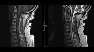 Using mri data of 1,211 asymptomatic subjects, the standard values for the cervical spinal canal, dural tube, and spinal cord for healthy members of each sex . Noncontrast Mri Cervical Spine Search Pattern