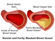 THE PROBLEM WITH HIGH CHOLESTEROL. CLEAR AND PARTLY BLOCKED BLOOD VESSEL.