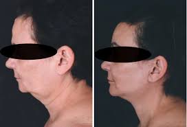 Importance of the Pontes Peninsula in Rhytidoplasty