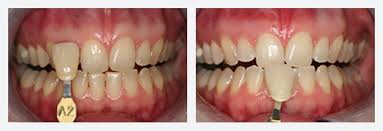 Additionally, this option uses a stronger whitening formula to help generate faster results. Whiten Teeth With Zoom Teeth Whitening Bow Lane Dental