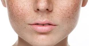 Pigmentation Treatments