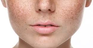 Best Treatments for Face Pigmentation, How to Treat Hyperpigmentation, Dark  Spot Treatments