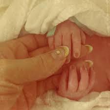 臨月 死産 原因