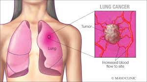 When signs of the disease start to appear, they can include: Mayo Clinic Q And A Lung Cancer Symptoms And Prevention