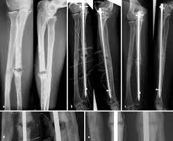 Intramedullare Nagelosteosynthese Der Ulna In Der Revisionschirurgie Springerlink