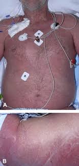 References In Staphylococcal Scalded Skin Syndrome And Toxic Shock Syndrome After Tooth Extraction Journal Of The American Academy Of Dermatology