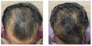Regrow Your Hair Naturally No Random Diets Topicals Massages Use Lab Testing To Scientifically Reverse Hair Reverse Hair Loss Hair Loss Diffuse Hair Loss