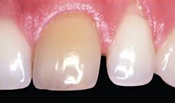 Aside from the stain, a tooth like we're describing here is otherwise fine. Whitening Traumatized Teeth Dear Doctor Dentistry Oral Health