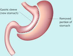 Read Ahead For Some Tips On How To Choose The Best Medical Tourism Agency Llc Some People Are Losing Out On Sleeve Gastrectomy Gastric Sleeve Sleeve Surgery