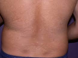 It is pink or coppery in pale subjects, but on tanned skin the patches are pale brown, since tanning does not occur in the affected areas. Kleienpilzflechte Pityriasis Versicolor Deximed