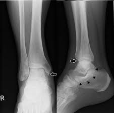 Sometimes, a medial malleolus fracture may result in impaction of the ankle joint, which is when force drives one bone into another. Medial Ankle Impingement Syndrome With Talocalcaneal Coalition Treated By Arthroscopy Assisted Resection A Case Report Springerlink